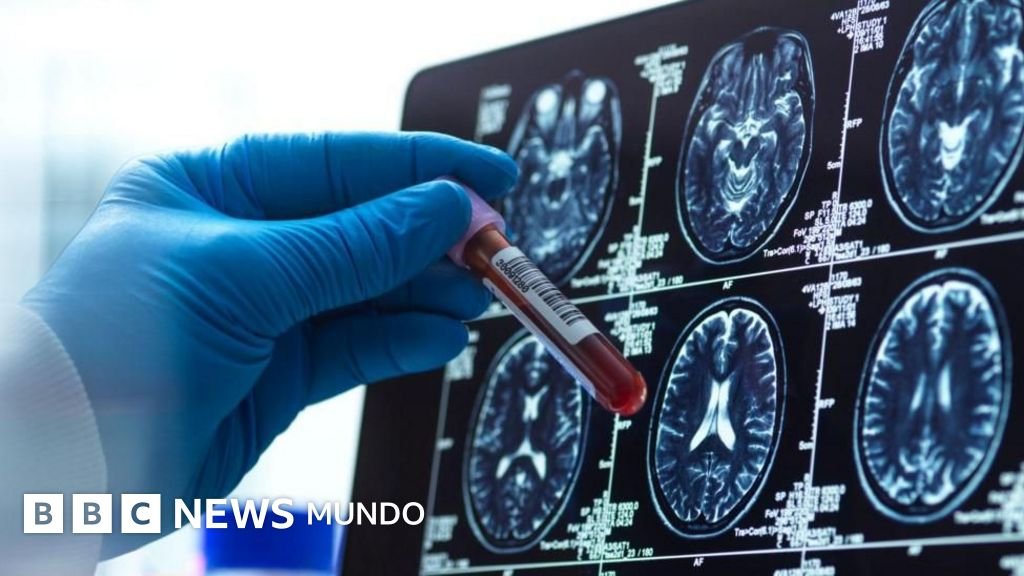 Cuatro innovaciones prometedoras para el tratamiento del Alzheimer en 2023